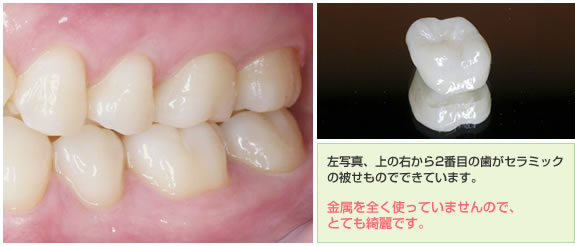 左写真、上の右から2番目の歯がセラミックの被せものでできています。金属を全く使っていませんので、とても綺麗です。